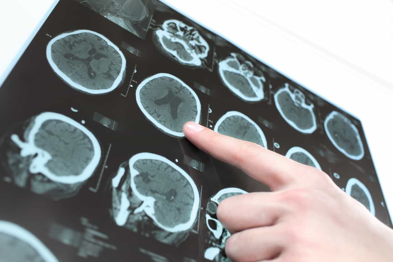 Analyzing Why MRI Characteristics of IIH Do Not Predict Headache and Visual Outcomes