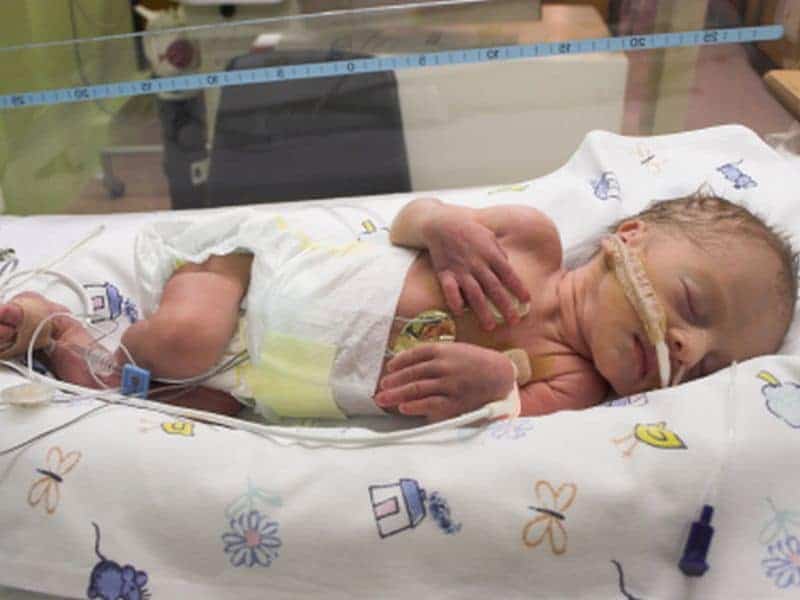 Most Preemies Survive Into Adulthood Without Major Comorbidities