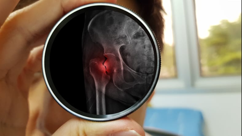 Integrated Fragility Hip Fracture Program Improves Outcomes