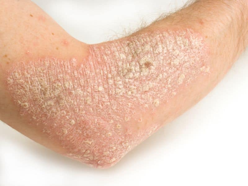Counseling for Risk Factors for Patients With Psoriasis/PsA Uncommon
