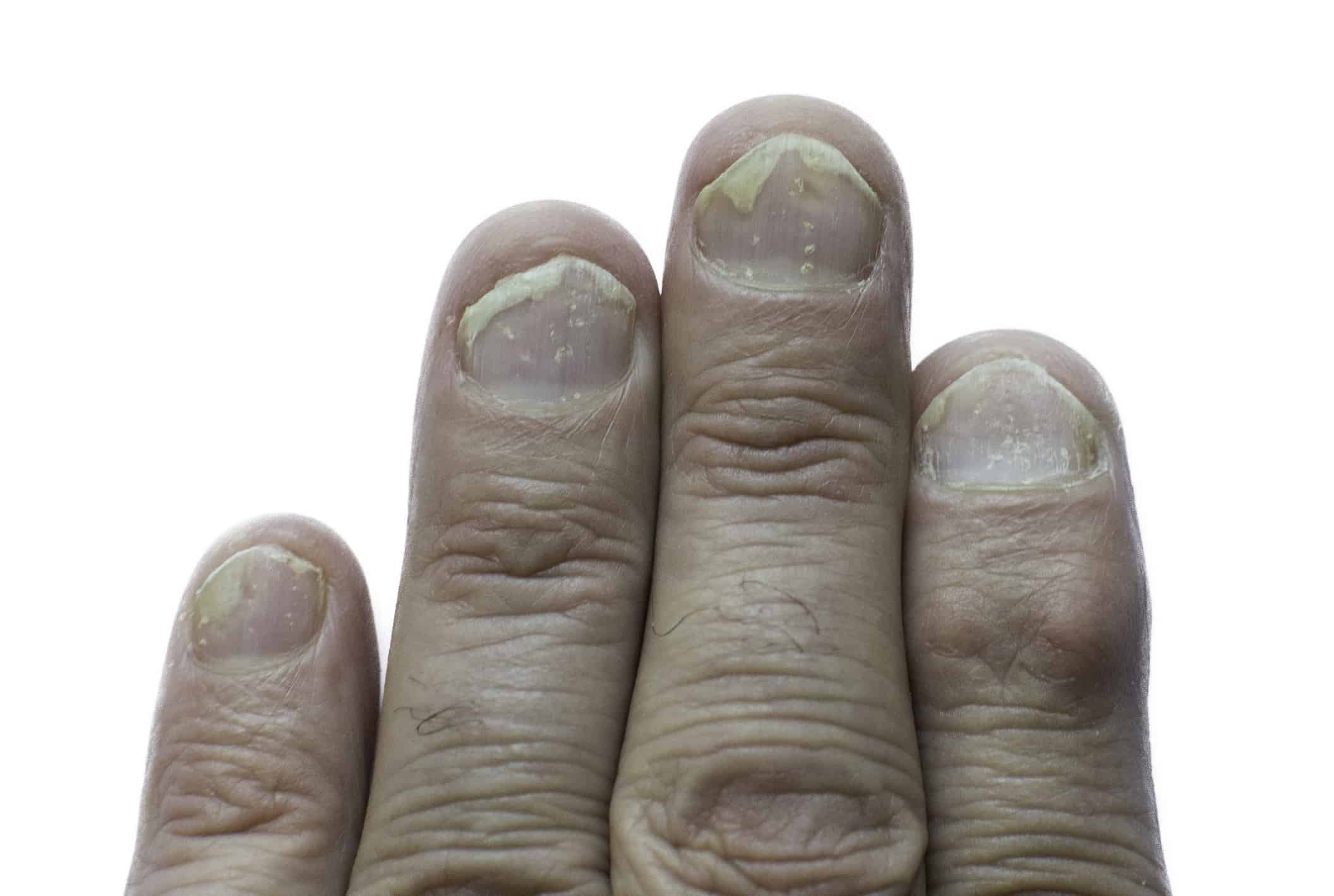 The Impact of Nail Psoriasis in Patients With Psoriatic Arthritis