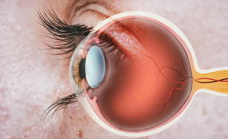 Exploring Trabeculectomy's Role in High Myopia Eyes